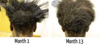 Cordeiro also recommends avoiding heavy styling creams, gels and pomades that can weigh down hair, making it look thinner and greasy. Afro Caribbean Hair Loss
