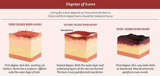 Caring For Minor Burns