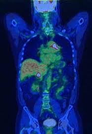 Doctors often order a pet scan for those. Pet Ct Positron Emission Tomography Computed Tomography