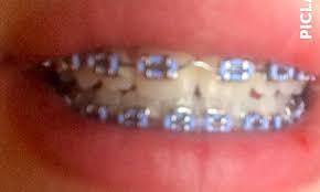 Light Blue Braces Light Blue Braces Braces Light Blue