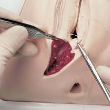 Daca operatia de cezariana este modalitatea aleasa de viitorii parinti pentru a. Epiziotomia