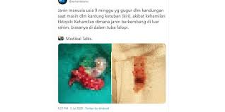 Kehamilan ektopik harus segera ditangani karena dapat berbahaya, dan janin juga tidak akan berkembang dengan normal. Twit Viral Janin Berusia 9 Minggu Yang Gugur Karena Hamil Ektopik Apa Itu Halaman All Kompas Com