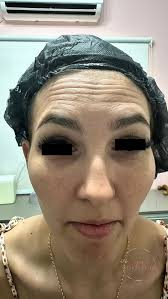 Aquele antes e depois do nosso maravilhoso Botox, Feito na região dos  olhos, nos temidos pés de galinha!, O resultado? Rejuvenescimento e  naturalidade., _, #campogrande #beleza #autoestima #botox