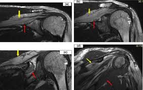 In morphologic and functional terms, the biceps femoris muscle is considered to be a double muscle, with the long head arising from the medial facet of the ischial tuberosity (, fig 2,) and the short head arising from the lateral linea aspera, lateral supracondylar line, and intermuscular septum.the short head is the only component of the hmc that does not span two. Reliable Mri And Mrn Signs Of Nerve And Muscle Injury Following Trauma To The Shoulder With Emg And Clinical Correlation Sciencedirect