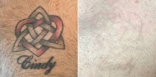 Inches at eminence medical aesthetics (up to 75% off). Red Pink And Black Chest Tattoo Removal