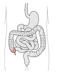 Mobile Cecum | Image | Radiopaedia.Org