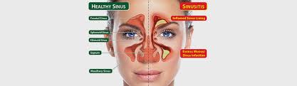 Image result for Sinus Surgery