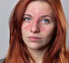 Image result for ekzema face