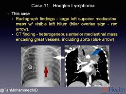 B) they are radio opaque. Case 11 Answers In Which Chest Compartment Is