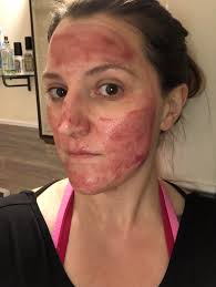 In general, a product may be less risky if it has an aha concentration of 10% or less, and a bha concentration of 1% to 2%. First Time Using The Ordinary Aha Bha Peel Did I Apply Enough Everything I Ve Read Said A Little Goes A Long Way Skincareaddicts