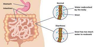 9) world gastroenterology organisation (wgo).world gastroenterology organisation global guidelines: Diarrhoea Causes Symptoms Treatment Support Guts Uk
