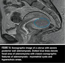Adenomyosis And Its Impact On Fertility