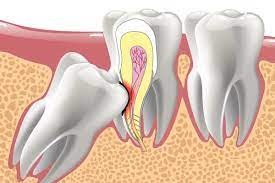 It's very common to have these teeth extracted, mainly from bad positioning and cavities. How Much Does Wisdom Tooth Removal Cost Tsawwassen Family Dental