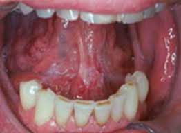 Depends on much tongue has to be removed and what type of reconstruction is performed. Oral Cancer Images The Oral Cancer Foundation