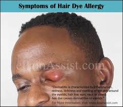 Continual use will result in more severe reactions over time and you could end up at the er in. Can Hair Dye Cause Allergic Reaction