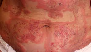 This causes the surface keratinocytes of the epidermis. Doenca Penfigo Tipos E Tratamento