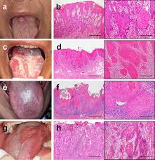 Image result for cancer of tongue