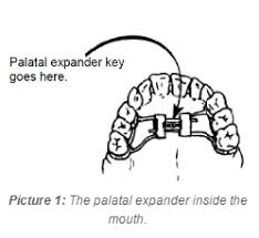 Dental Wearing A Palatal Expander