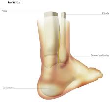 Related online courses on physioplus. Ankle Posterolateral Approach Approaches Orthobullets