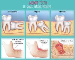 Some people may be able to keep their wisdom teeth if they do not cause any problems. Wisdom Teeth Extractions Treatment Service In Kolkata Kolkata Global Dental Wellness Id 19993011991