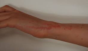 Piqure, traitement, photo, bouton, cause et symptômes, comment s'en débarrasser lire la suite comment savoir si on a des punaises de lit ? Neature Punaise De Lit