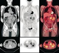 African americans are more likely than asians, hispanics, or whites to get pancreatic cancer. A 43 Year Old Woman With Pancreatic Cancer Presented For Evaluation Of Download Scientific Diagram