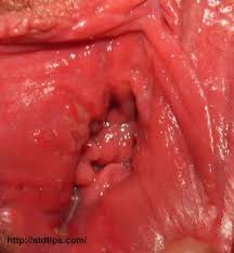 Image result for trichomonas images