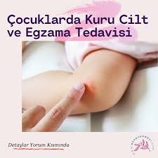 Cocuklarda Kuru Cilt Ve Egzama Tedavisi Kuru Cilt Cocuk Kursun