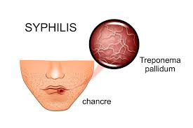 Image result for syphilis symptoms