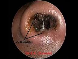 Nasal vestibulitis is the infection of the vestibule inside the opening of the nostril. Nose Endoscopy Vestibulitis Due To Chronic Sinusitis Allergy Adenoiditis Pnd Youtube