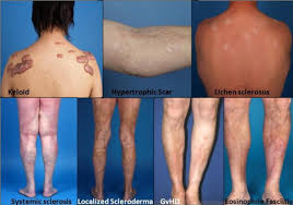 Image result for Connective Tissue Disorder