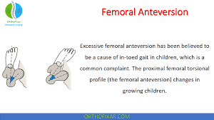 Image result for Femoral Retroversion