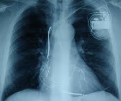 We did not find results for: Kardiologie Herzschrittmacher Defibrillatoren Kardiale Resynchronisations Therapie