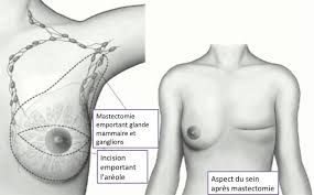 Comment ca se passe ? La Chirurgie Reconstructrice Du Sein Apres Cancer