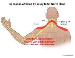 C5 And C6 Nerve Damage Symptoms Pictures To Pin On Pinterest Nerve Damage Symptoms Nerve Damage Nerve