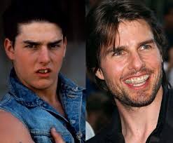 Here is a selection of celebrities who have also had veneers (you can click on the pics to make them bigger) cheryl cole: Here S What We Know About Tom Cruise And His Strange Teeth