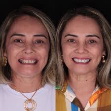 Uma paciente muito querida confiou em meu trabalho para realizar a  instalação de dentes fixos sem corte ou cirurgia, associada às facetas em  resina. O resultado não poderia ser diferente: um sorriso