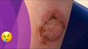 Image result for spinne biss haut reaktion