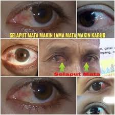 Siapa Nak Ikhtiar Hilangkan Masalah Toner Ainun Beauty Mata Ikhtiar Masalah Rabun Silau Selaput Katarakk Facebook