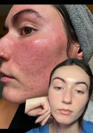 Bioderma Oil Before and After