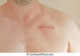 Blindedarmontsteking is een ontsteking van de appendix, die hevige pijn in de buik veroorzaakt. Litteken Hart Chirurgie Stockfoto Beelden 221 Litteken Hart Chirurgie Royalty Vrije Afbeeldingen En Foto S Van Duizenden Stockfotografen Schikbaar Voor Aankoop