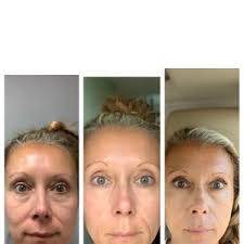It is a small vial that has hollow, 24 karat gold plated microneedles that will inject the fluid directly into the skin. Aquagold Reviews Was It Worth It Realself