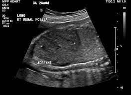 Mwfcc Conditions Renal Agenesis Children S Minnesota