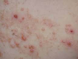 Maybe you would like to learn more about one of these? Molluscum Contagiosum Dermnet Nz
