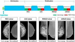 Image result for Mammogram Interpretation