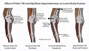 Check spelling or type a new query. Pelvic Tilt