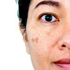 Image result for Melasma