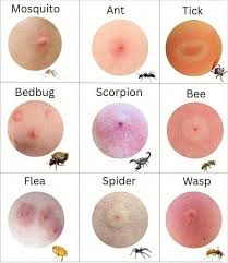 Image result for mosquito bite