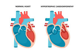 Image result for Cardiomyopathy