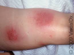 Image result for erythema nodosum